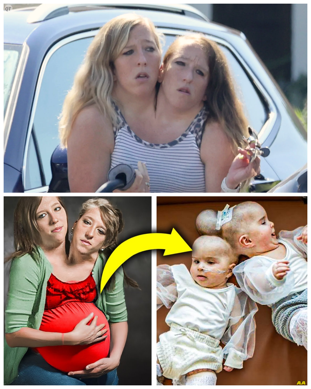 “Mother of Conjoined Twins Breaks Silence: The Horrifying Truth Behind the Rumors!” In a shocking revelation that has left the world gasping, the mother of conjoined twins has confirmed the dreadful rumors swirling around her family’s situation, and the details are nothing short of chilling! “I never thought I’d have to defend my children like this,” she exclaimed, as she bravely faced the media storm. As she unveils the heartbreaking realities of their lives, the question looms: what lies beneath the surface of this extraordinary family, and how will they navigate the challenges ahead? As the truth unfolds, the stakes couldn’t be higher for this devoted mother and her precious children!  The full story is in the comments below.