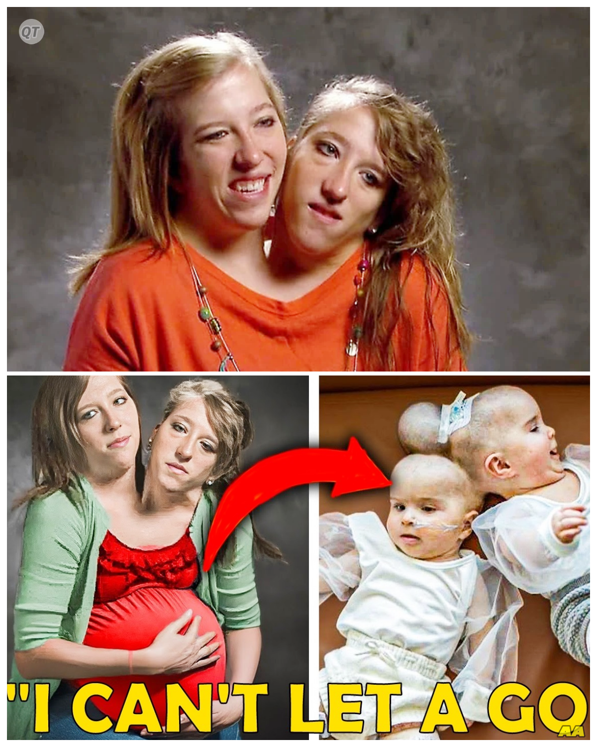 “Conjoined Twins’ Mother Breaks Silence: Horrible Rumors Are True! -ZZ”  In a shocking confession, the mother of conjoined twins has confirmed that the horrible rumors surrounding their lives are indeed true. What revelations has she shared, and how have these experiences shaped their family dynamic? Join us as we explore the heartbreaking realities faced by this family, shedding light on their journey and the challenges they continue to overcome!